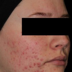 AviClear Before & After Patient #1672
